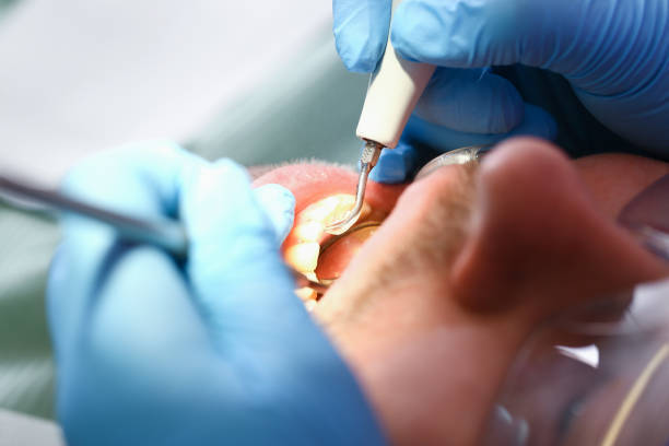 Best Emergency Root Canal Treatment in Herculaneum, MO